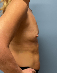 Breast Augmentation