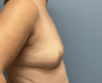 Breast Augmentation