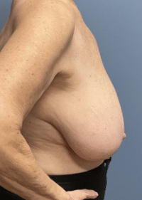 Breast Lift