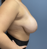 Breast Lift