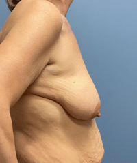 Breast Lift with Augmentation