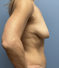 Breast Lift with Augmentation