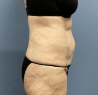 Circumferential Body Lift