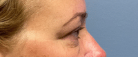 Eyelid Surgery