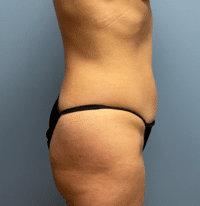 Liposuction