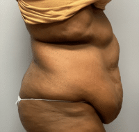 Panniculectomy