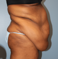 Panniculectomy