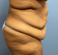 Tummy Tuck