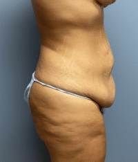 Tummy Tuck