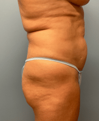 Tummy Tuck
