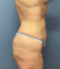 Tummy Tuck