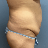 Tummy Tuck