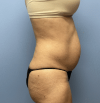 Tummy Tuck