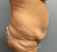 Tummy Tuck