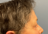 Brow Lift