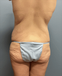 Circumferential Body Lift