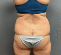 Tummy Tuck