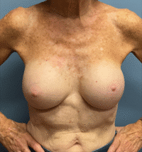 Breast Implant Removal