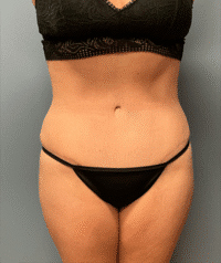 Tummy Tuck