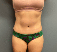Tummy Tuck