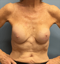 Breast Implant Removal