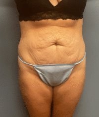 Tummy Tuck
