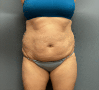 Tummy Tuck