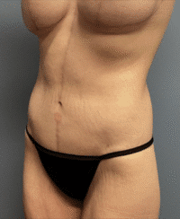 Circumferential Body Lift