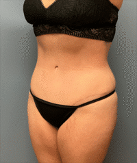 Tummy Tuck