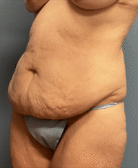 Circumferential Body Lift