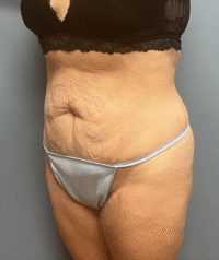 Tummy Tuck