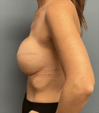 Prepectoral Reconstruction