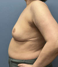 Breast Reduction