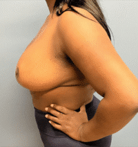 Breast Reduction