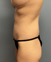 Circumferential Body Lift