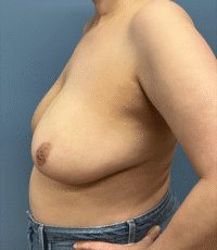 Breast Reduction