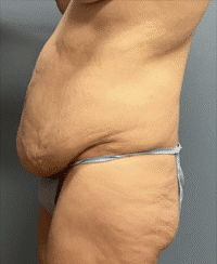 Circumferential Body Lift