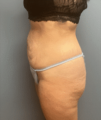 Tummy Tuck