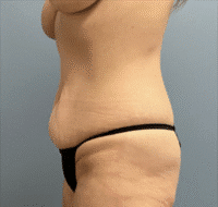 Tummy Tuck