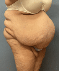 Panniculectomy