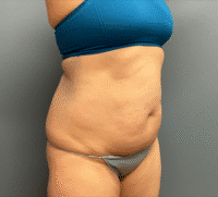 Tummy Tuck