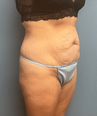 Tummy Tuck