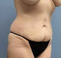 Tummy Tuck