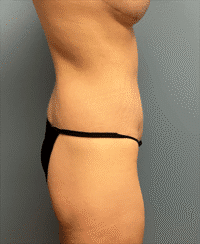 Circumferential Body Lift
