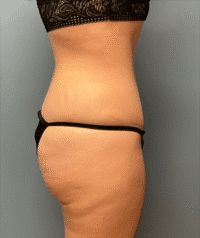 Tummy Tuck