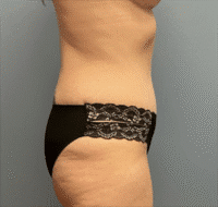 Tummy Tuck