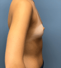 Breast Augmentation