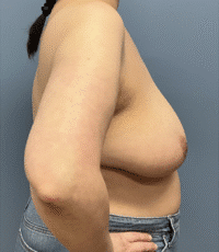Breast Reduction