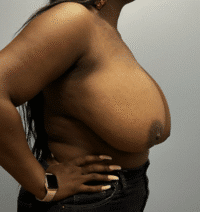 Breast Reduction