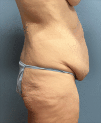 Circumferential Body Lift